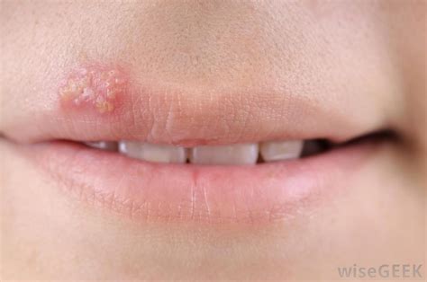 clear blister on inside of lip - pictures, photos