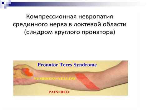 Невропатия лучевого, локтевого и срединного нервов - online presentation