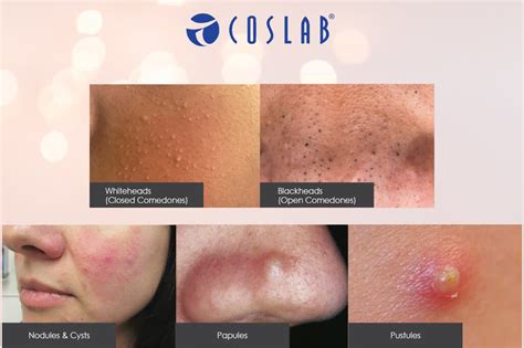 Period Acne. Why do we get them? | Coslab Beauty Spa