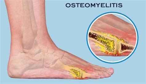 Osteomyelitis: Causes, Diagnosis and Treatment - Good Health Plan