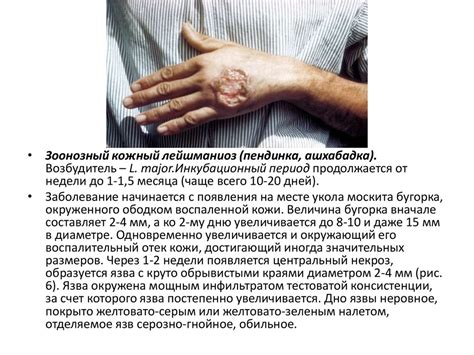 Лейшманиозы. Основные формы лейшманиозов - презентация онлайн