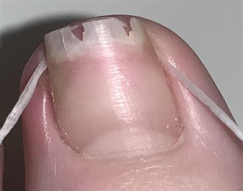 results     floss   nail hack ringrowntoenails