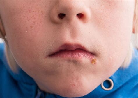 Impetigo On Nose Treating Impetigo/mild Staph Infection On Lower Part