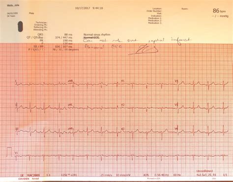 Infarction Ekg Septal Infarct