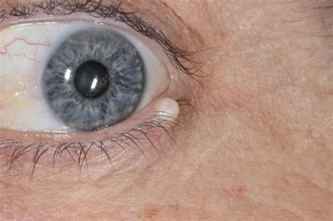 cyst   womans  lid stock image  science photo