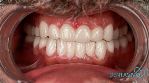 Before & After - Dentavivo