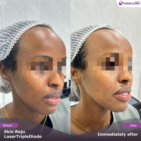 Brightening Treatment Before and After Photos - Siam Clinic Thailand