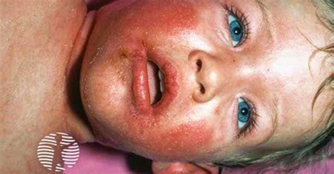 Staphylococcal scalded skin syndrome image