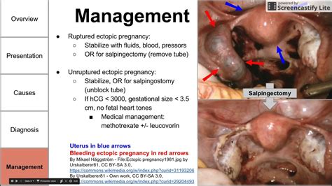 Ectopic pregnancy - YouTube