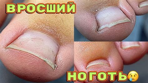 Вросший ноготь / Трапеция на ногах / Секреты педикюра - YouTube