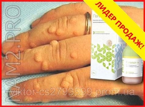 Папилайт - Комплекс от папилломавируса и бородавок, цена 199 грн ...