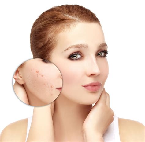 cara menghilangkan bintik bintik di badan 6