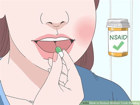 How to Reduce Wisdom Tooth Swelling: 10 Steps (with Pictures)