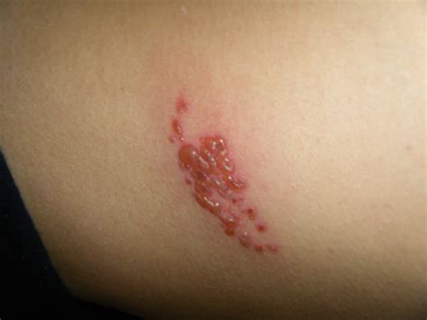 21 and Shingles: DAY 9: blisters SLOWLY oozing