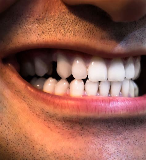 missing teeth treatment berwick alira smiles dental