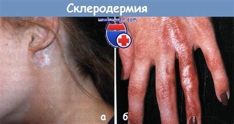 Склеродермия у ребенка
