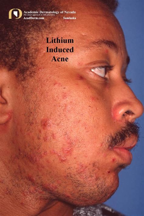 Acne Medicamentosa