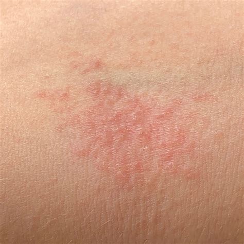 atopic dermatitis icd    consultation ai dermatologist