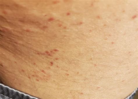 Sweat/heat rash? Lasted more than a week so far, doesn't help that I ...