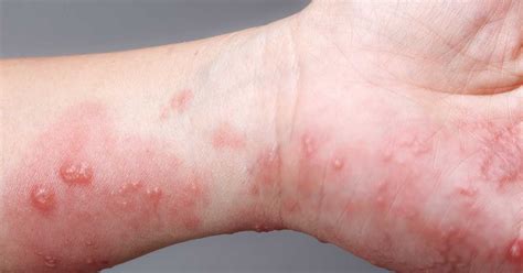 5 Common Skin Rash Types and their Symptoms! | Marham