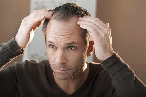 Effective Male Pattern Baldness Treatment In Ogden Utah