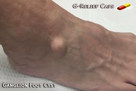 ganglion cyst foot surgery alternative  relief caps  natural relief