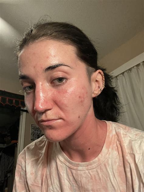 My skin still feels raw and is weeping/peeling after almost five months