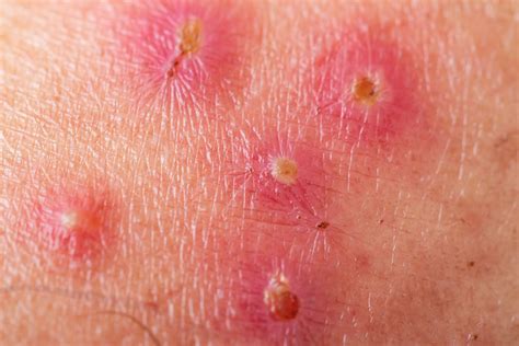 Impetigo Treatment and Antimicrobial Resistance