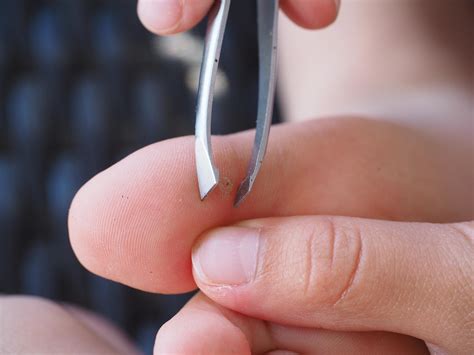 foreign bodies medlineplus