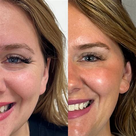 Botox & Dysport | Enhance Your Look Today — LakeOconeeMedspa.com