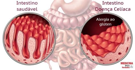 O Que É Uma Doença Celíaca - Alergia ao glúten: doença celíaca pode provocar a morte | Medicina ...