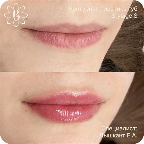 До и после контурной пластики - фото | клиника «Красивые люди» в Петербурге