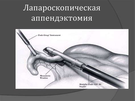 Острый аппендицит - презентация онлайн