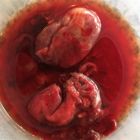 what does the blood of a miscarriage look like 2