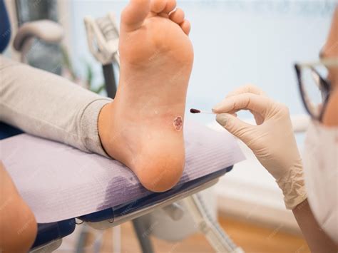 Premium Photo | Podiatrist treating a verruca on a patient39s foot
