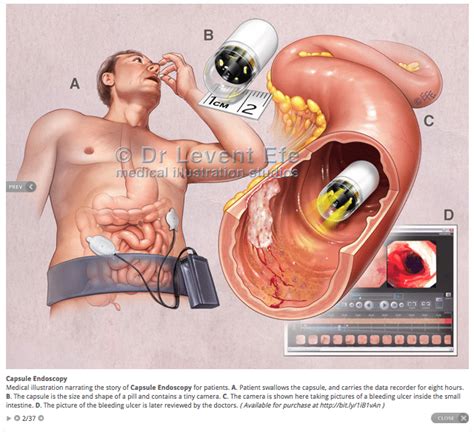 Capsule Endoscopy