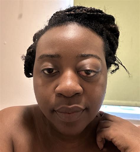 ‘Doctors told me it was a simple stye – then my eye was bulging out of