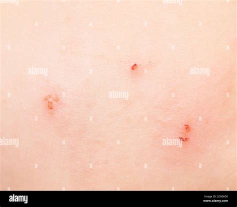 bite wound human  res stock photography  images alamy