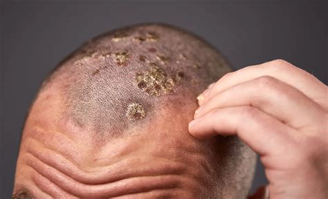 Mild Scalp Psoriasis Symptoms