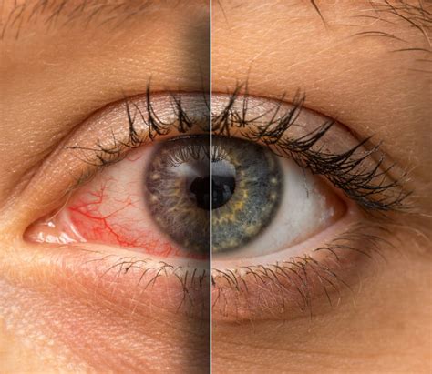 Red Eye Symptoms And Treatment