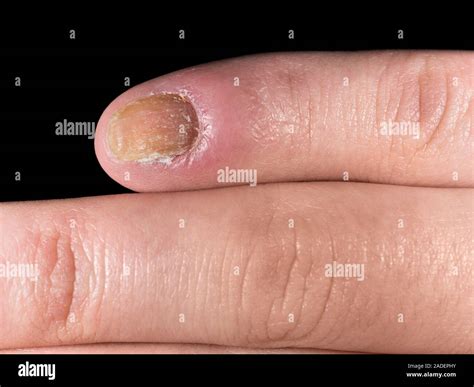 candidiasis   fingernail nail infection  inflammation