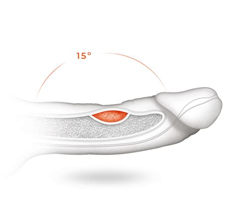 Peyronie’s disease (curved penis): causes and symptoms