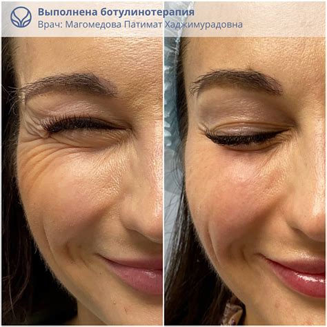Ботулинотерапия (ботокс лица) в СПб: цены, запись на процедуры ...