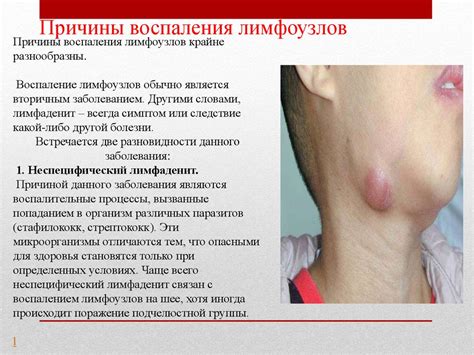 Лимфаденит. Лимфоузлы - презентация онлайн