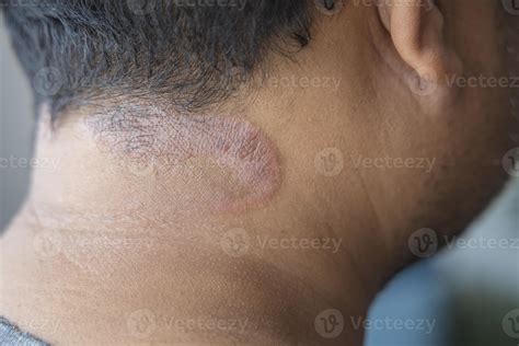 Dark-skinned Asian men suffer from scalp dermatitis due to moisture ...