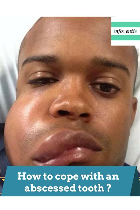 abscess tooth stages   actions