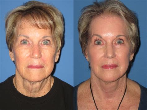 facelift face lift facelift     uqcc