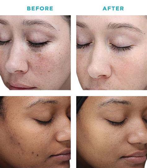 peels revitalize  vi peel treatments bijin