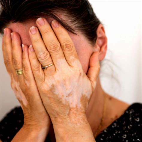 Vitiligo Care - Dolphin IBA