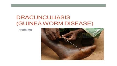 Dracunculiasis